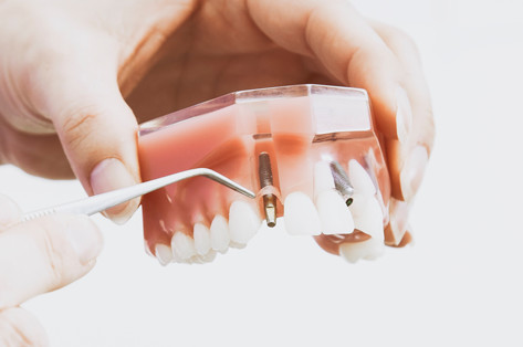 インプラントの画像